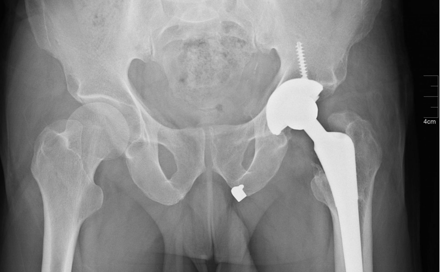 Antibiotic prophylaxis before dental treatment Seattle Smiles Dental